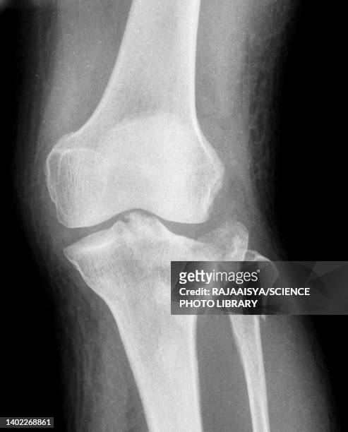 tibial plateau fracture, x-ray - comminuted fracture stock pictures, royalty-free photos & images