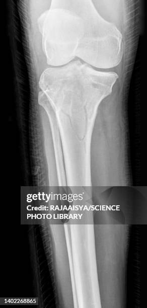 tibial plateau fracture, x-ray - knochenbruch stock-fotos und bilder