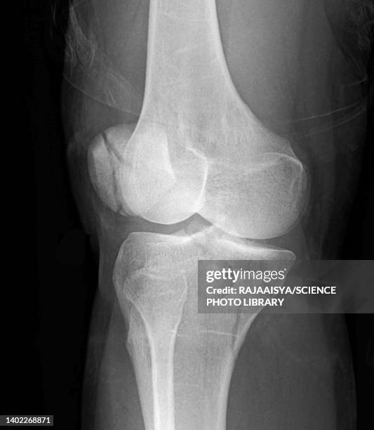 tibial plateau fracture, x-ray - comminuted fracture stock pictures, royalty-free photos & images