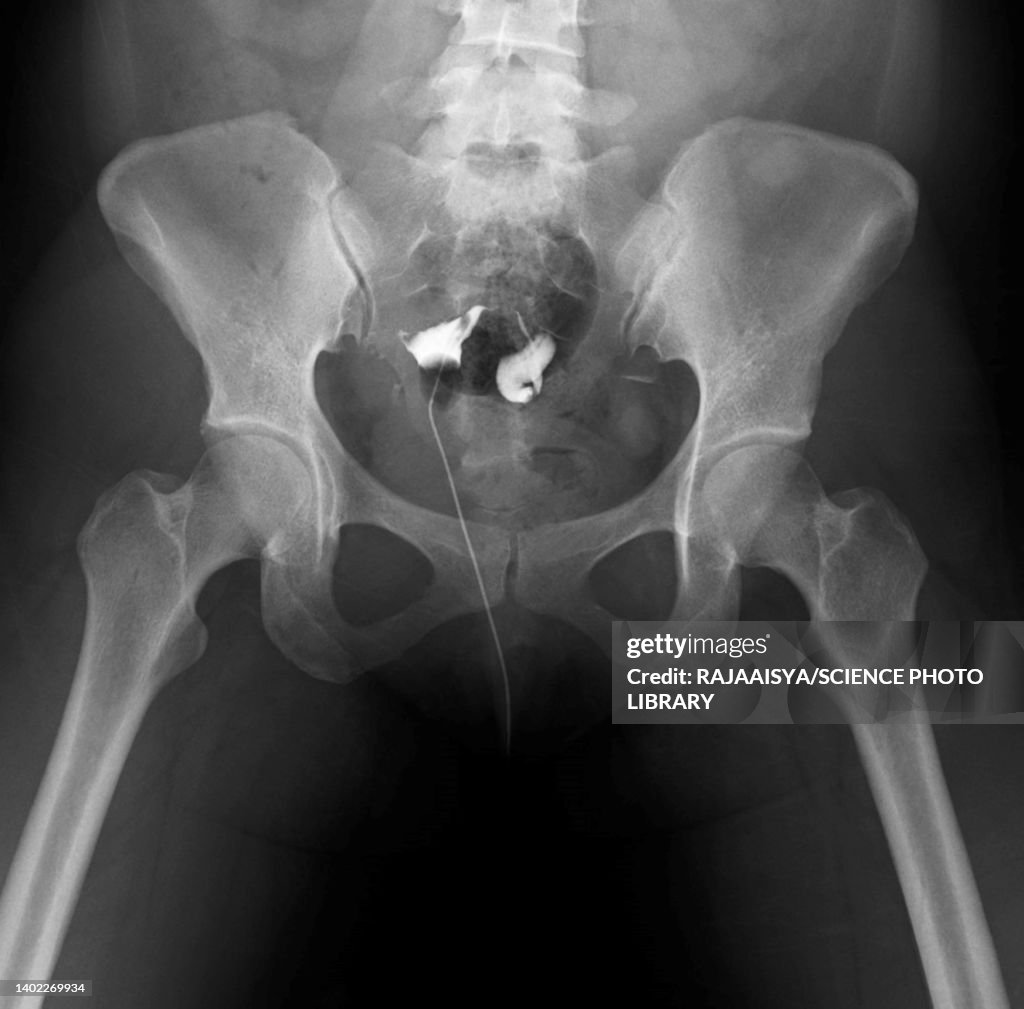 Fallopian Tube Clips Radiology Obstructed Fallopian Tubes Xray Photo - Getty Images
