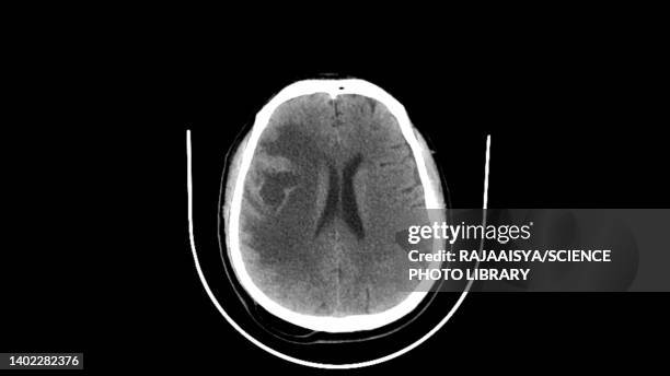 brain metastasis, ct scan - tumore metastatico foto e immagini stock
