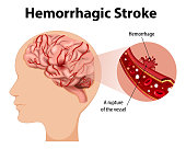Human with Hemorrhagic stroke