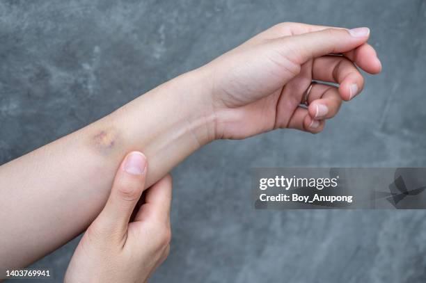 a bruise on woman hand. females tend to bruise more easily than males. - skin cross section stock pictures, royalty-free photos & images