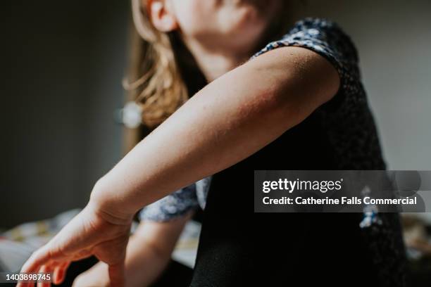 a close-up, focusing on a little girls arm - dermatitis stock pictures, royalty-free photos & images