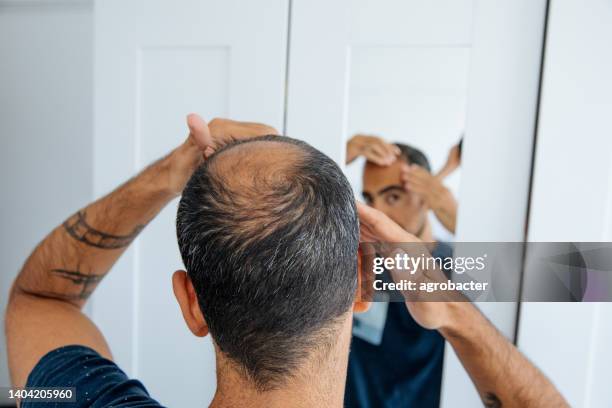 hombre calvo mirando espejo de cabeza pérdida de pelo y calvicie - dandruff fotografías e imágenes de stock