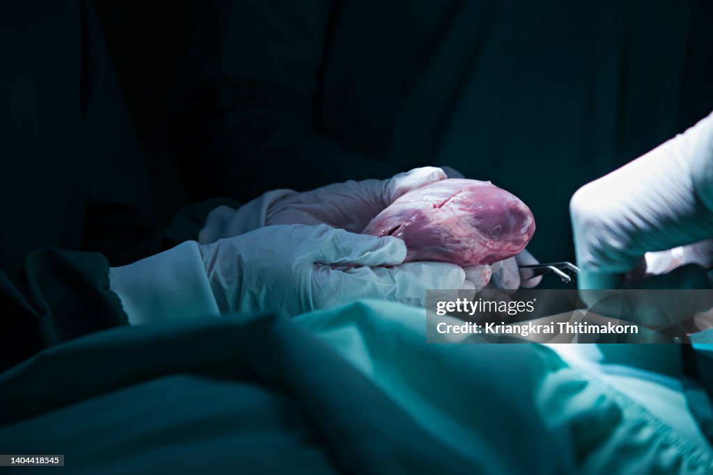 Surgeons are performing heart transplant in the operating room.