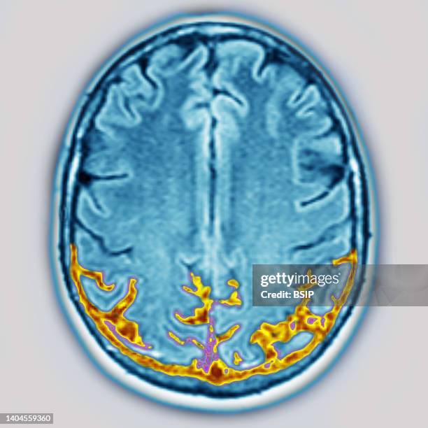 Cerebral atrophy - Posterior cortical atrophy (posterior cortical degeneration responsible for agnosia, apraxia, aphasia, Gerstmann syndrome,...