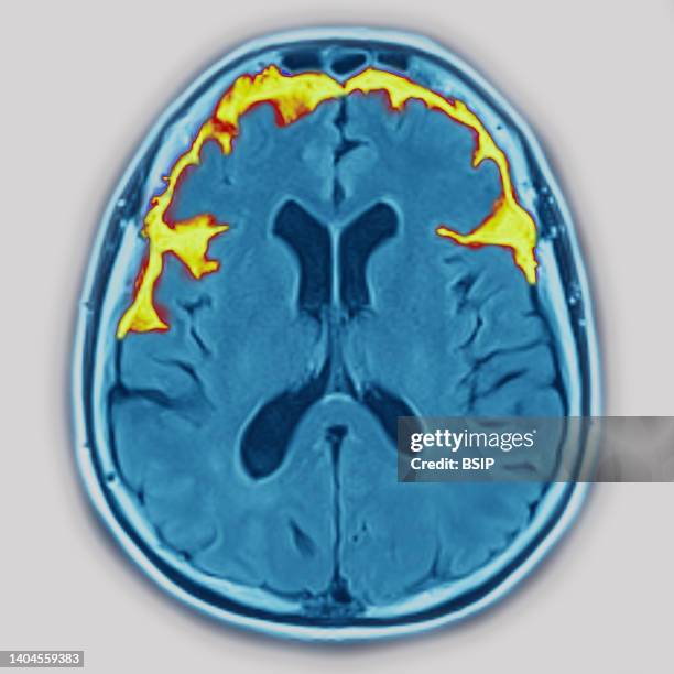 28 Frontotemporal Dementia Stock Photos, High-Res Pictures, and Images ...