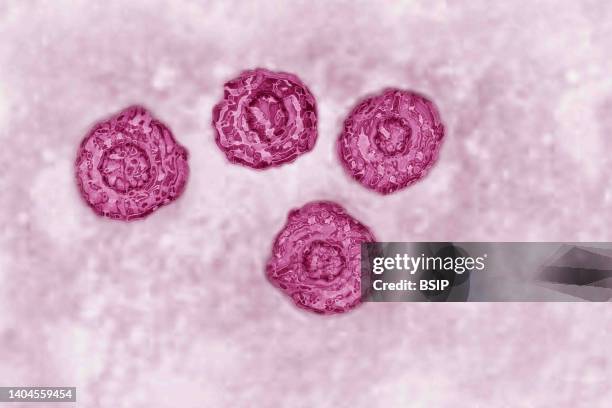 Hepatitis C virus . HCV causes blood-borne hepatitis, cirrhosis occurs in 25% of cases, 10 to 20 years after the onset of infection, with a risk of...