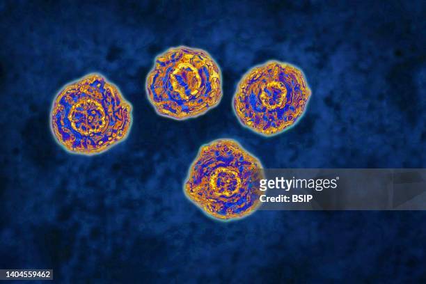 Hepatitis C virus . HCV causes blood-borne hepatitis, cirrhosis occurs in 25% of cases, 10 to 20 years after the onset of infection, with a risk of...