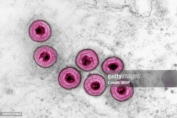 Herpes virus. HSV is the cause of cold sores, genital herpes, chickenpox, infectious mononucleosis, roseola, sometimes shingles. They are involved in...