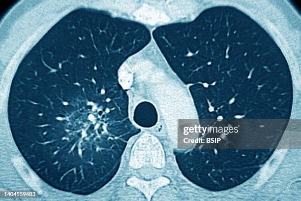 Pulmonary arteritis causing progressive occlusion of the bronchial arteries, seen by a radial CT scan of the lungs .