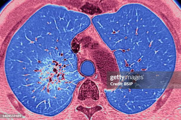 Pulmonary arteritis causing progressive occlusion of the bronchial arteries, seen by a radial CT scan of the lungs .