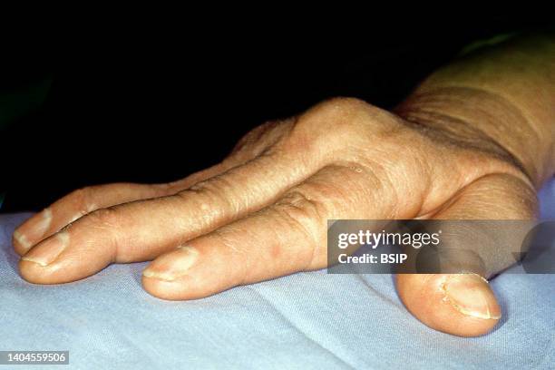 Joint deformities of a hand caused by rheumatoid arthritis .