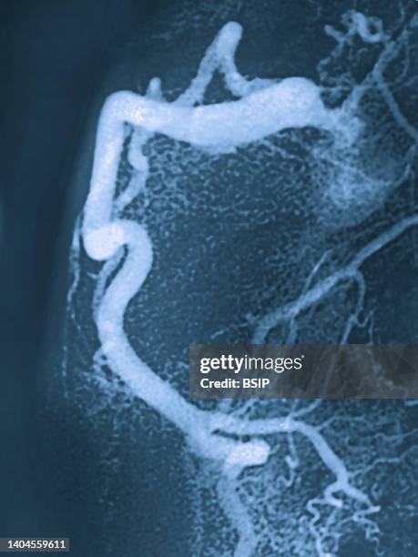 Angiogram Contrast Injection 126 Coronary Angiogram Stock Photos, High-Res Pictures, and Images ...
