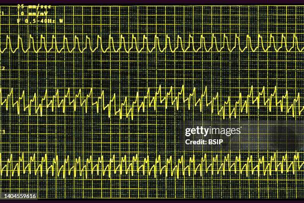 Atrial tachycardia electrocardiogram, heart rhythm disorder where the patient complains of rapid palpitation sensations.