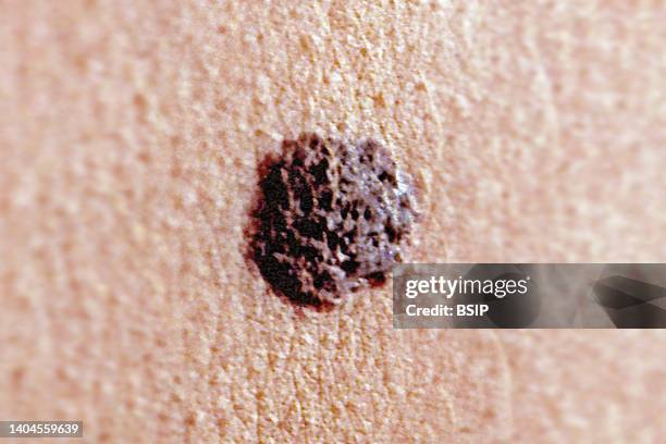 Malignant melanoma , developed at the expense of melanocytes .
