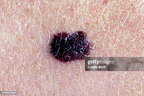 Malignant melanoma , developed at the expense of melanocytes .