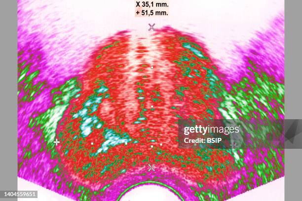 Scanner Prostate Prostate Cancer Scan Photos and Premium High Res Pictures - Getty Images