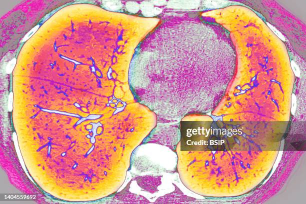 Of pulmonary cystic fibrosis . Radial MRI of the lungs.