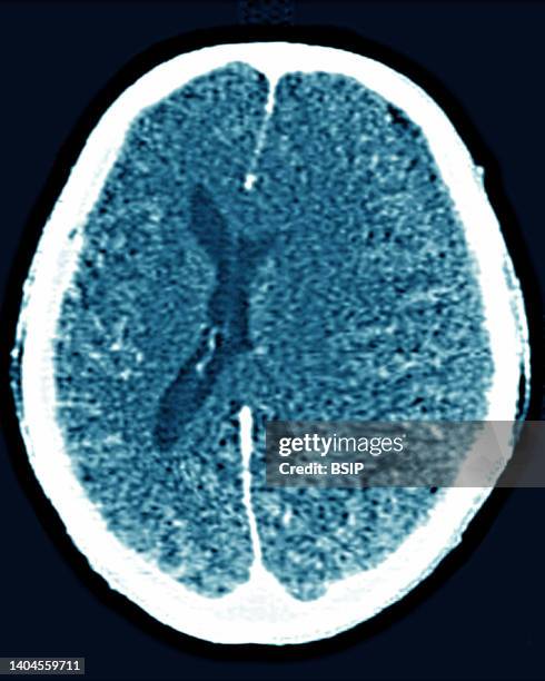 Scan of brain edema . Radial CT scan of the skull.