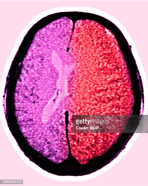 Scan of brain edema . Radial CT scan of the skull.