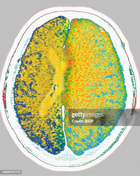 Scan of brain edema . Radial CT scan of the skull.