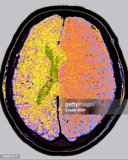 Scan of brain edema . Radial CT scan of the skull.