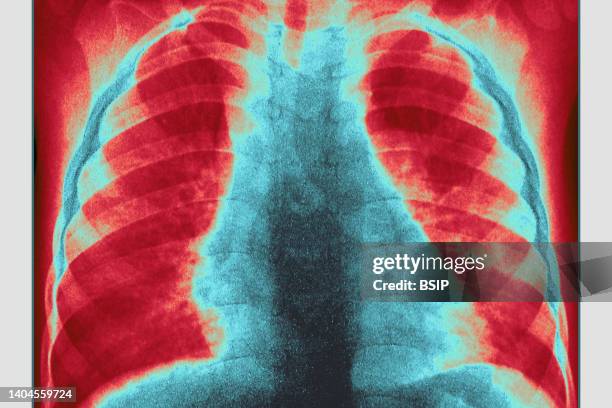 Chest x-ray of a child with measles pneumonia.