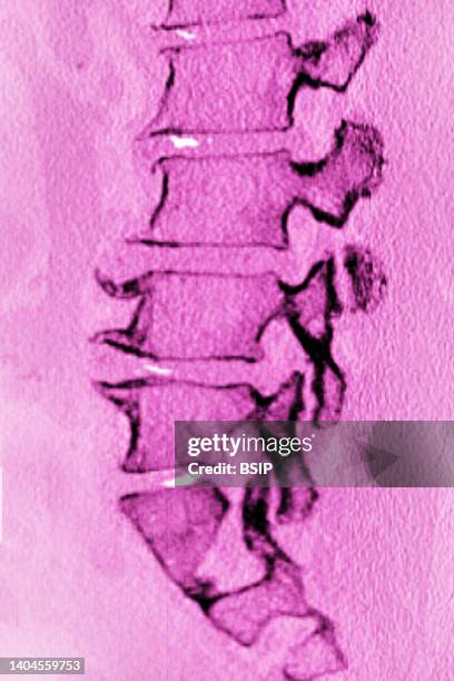 Significant degenerative lumbar disc disease in a 75-year-old woman. Spinal MRI in sagittal section.