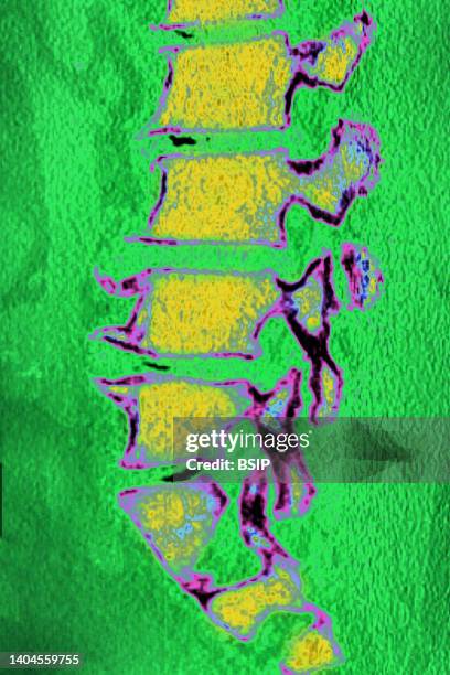 Significant degenerative lumbar disc disease in a 75-year-old woman. Spinal MRI in sagittal section.