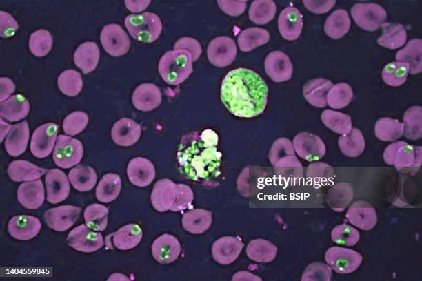 Plasmodium falciparum is a malaria-causing parasite or malaria, transmitted by the bite of female anopheles which releases merozoites into the blood...