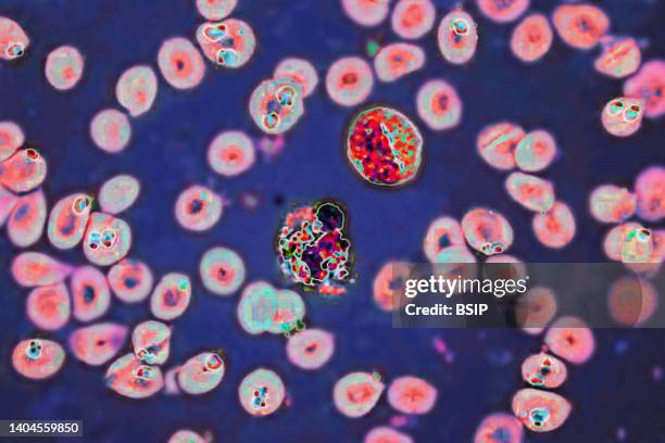 Plasmodium falciparum is a malaria-causing parasite or malaria, transmitted by the bite of female anopheles which releases merozoites into the blood...