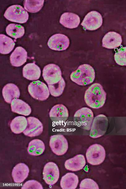 Plasmodium falciparum is a malaria-causing parasite or malaria, transmitted by the bite of female anopheles which releases merozoites into the blood...