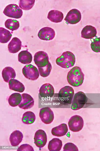 Plasmodium falciparum is a malaria-causing parasite or malaria, transmitted by the bite of female anopheles which releases merozoites into the blood...