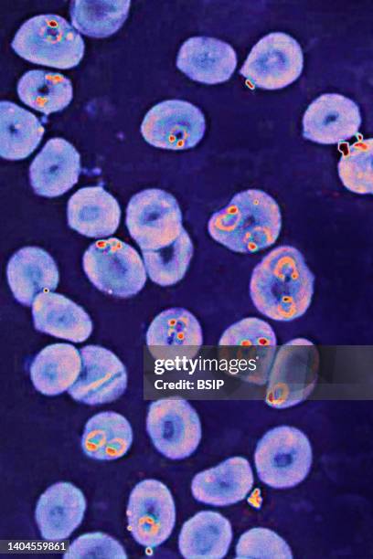 Plasmodium falciparum is a malaria-causing parasite or malaria, transmitted by the bite of female anopheles which releases merozoites into the blood...