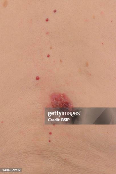 Basal cell carcinoma of the back in a 93-year-old man.