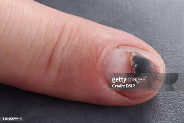 Subungual hematoma of the index finger in a 50-year-old man with healthy nail regrowth below.
