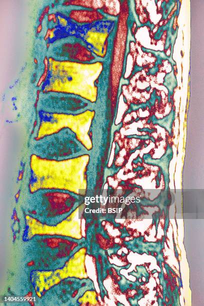 Osteoporosis on lumbar vertebrae. Sagittal MRI of the spine.