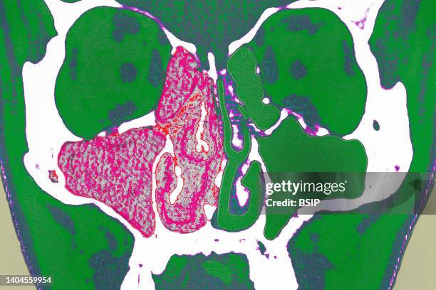 Sinusitis in the right maxillary sinus, visualized by cranial CT scan in frontal section.