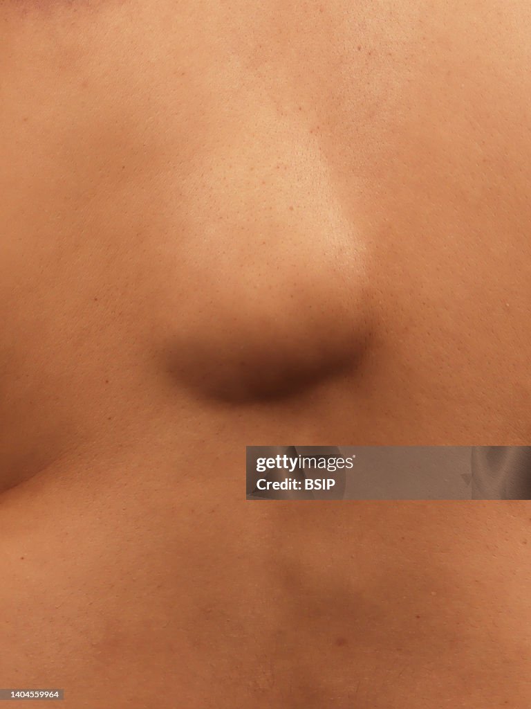 Lipoma