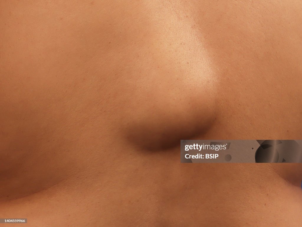 Lipoma