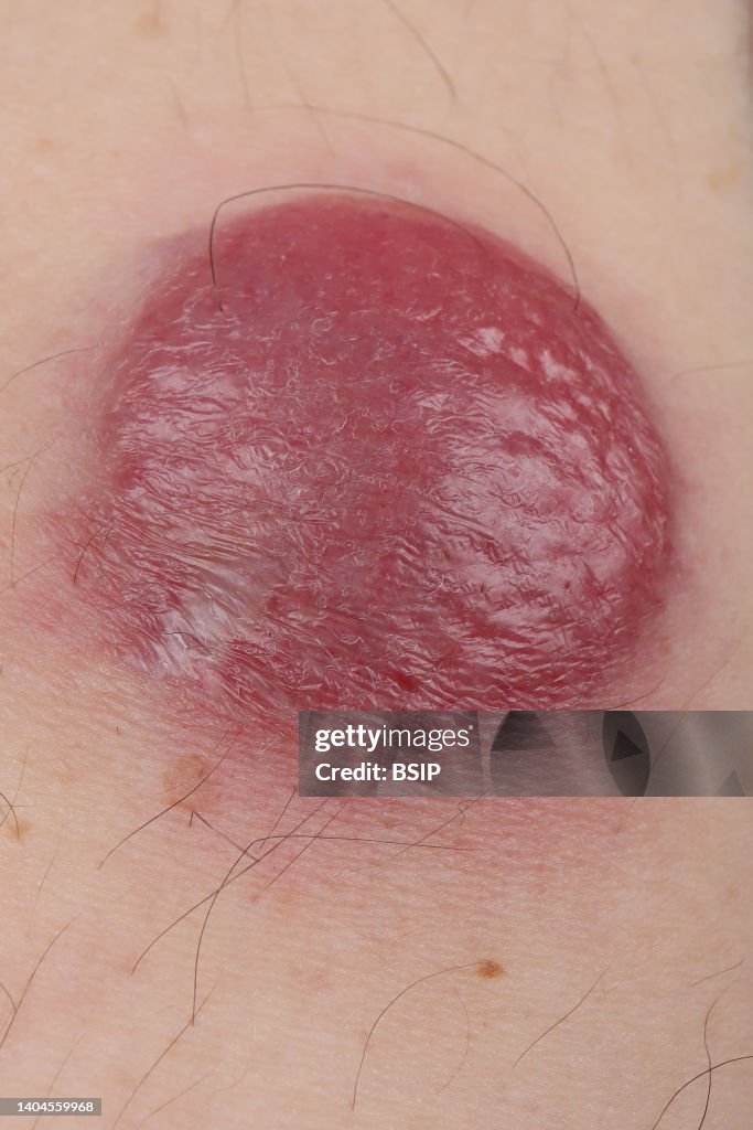 Merkel tumor