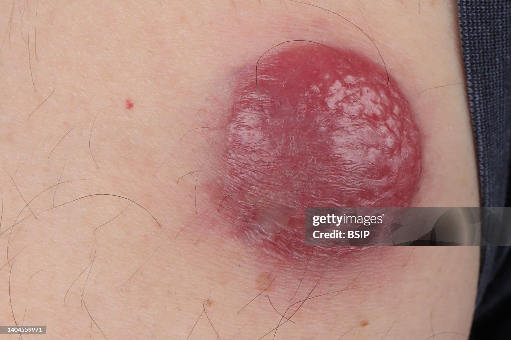 Merkel tumor