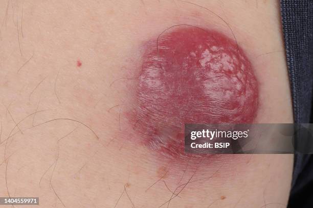 Merkel's tumor of the shoulder in a 61-year-old man.