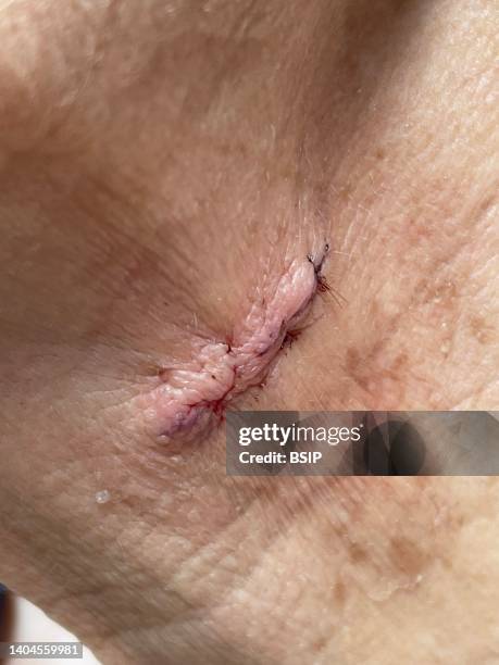 Exeresis of a basal cell carcinoma in the neck of a 72-year-old woman, one-day absorbable suture.