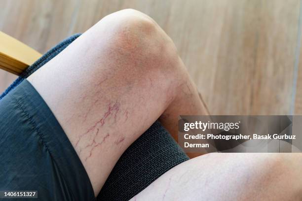 a woman's legs with varicose veins and spider veins - caillot sanguin photos et images de collection