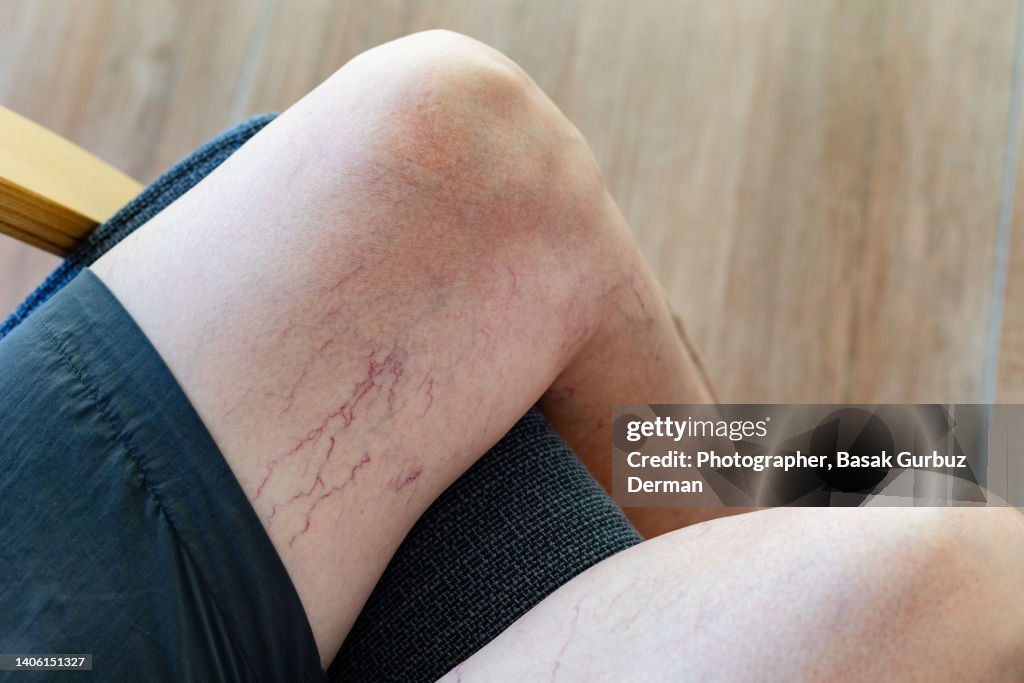 A woman's legs with varicose veins and spider veins