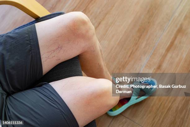 a woman's legs with varicose veins and spider veins - krampfadern stock-fotos und bilder