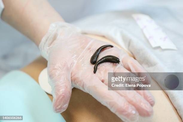 doctor showing medicinal leech on her hand - sanguijuela fotografías e imágenes de stock